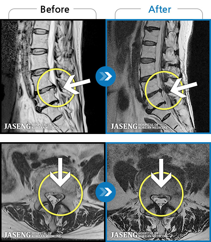 �ڻ��ѹ溴�� ġ���� MRI�� ���� ġ����-�㸮, ���� ��ݺ��� ���� �ٸ��� ���� �� ������ ���ӵǰ� ���� �ٸ��� ������ ����