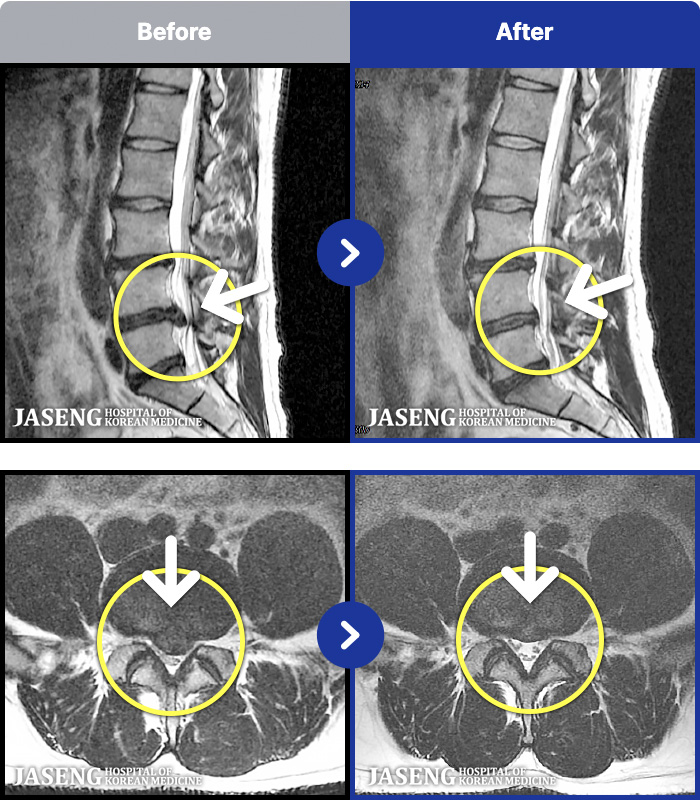 ����ڻ��ѹ溴�� ġ���� MRI�� ���� ġ����-���� �߰��� Ż�������� ���� �㸮 ������ �Բ� �ٸ� ������ΰ� ���� ���ļ� ������ �Ұ����� ���·� ����