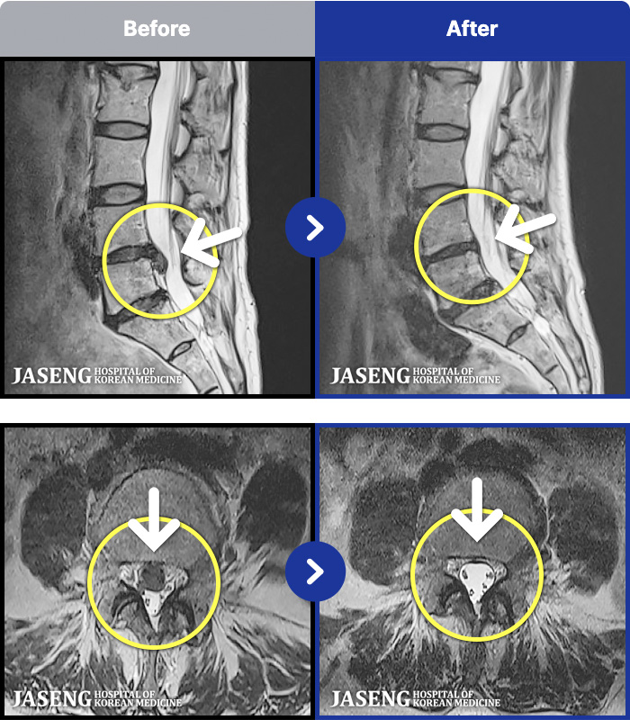 �����ڻ��ѹ溴�� ġ���� MRI�� ���� ġ����-�㸮�� ���� �ٸ��� ���� ����