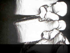 분당자생한방병원 허리질환 퇴행성디스크-정상척추에 관련된 이미지 입니다.