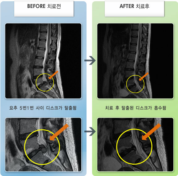 자생한방병원 치료사례 MRI로 보는 치료결과-허리 통증과 왼쪽 다리 저림으로 허리를 만지기만 해도 깜짝 놀랄 만큼 아픈 상태