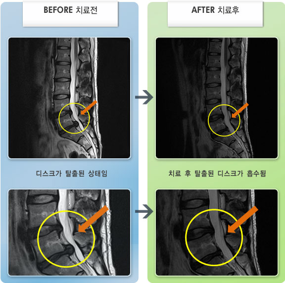 자생한방병원 치료사례 MRI로 보는 치료결과-허리 통증 및 왼쪽 엉덩이 통증