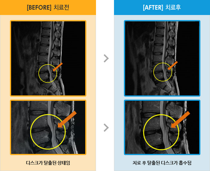 자생한방병원 치료사례 MRI로 보는 치료결과-장기간 앉아있을때 허리 통증