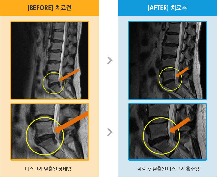 자생한방병원 치료사례 MRI로 보는 치료결과-왼쪽 다리 통증 저림이 있고 종아리가 시림