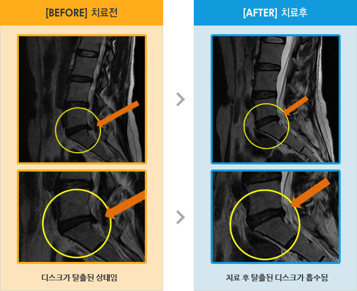 자생한방병원 치료사례 MRI로 보는 치료결과-다리양쪽 통증으로 모든 자세 시 통증