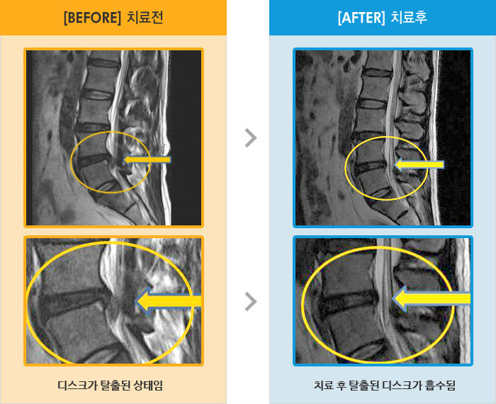 자생한방병원 치료사례 MRI로 보는 치료결과-허리 통증, 좌하지 방사통 저림
