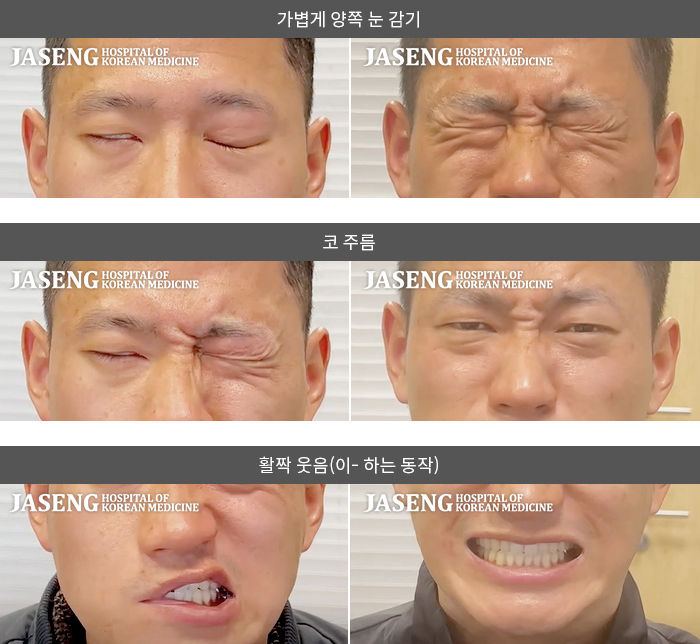 대구자생한방병원-안면신경마비 치료 사례