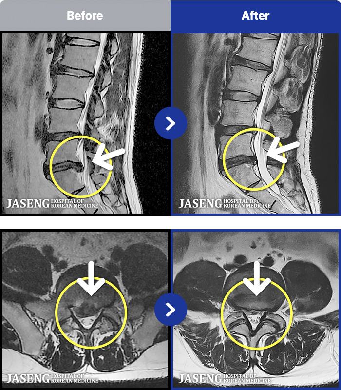 목동자생한방병원 치료 전후 MRI 비교 이미지