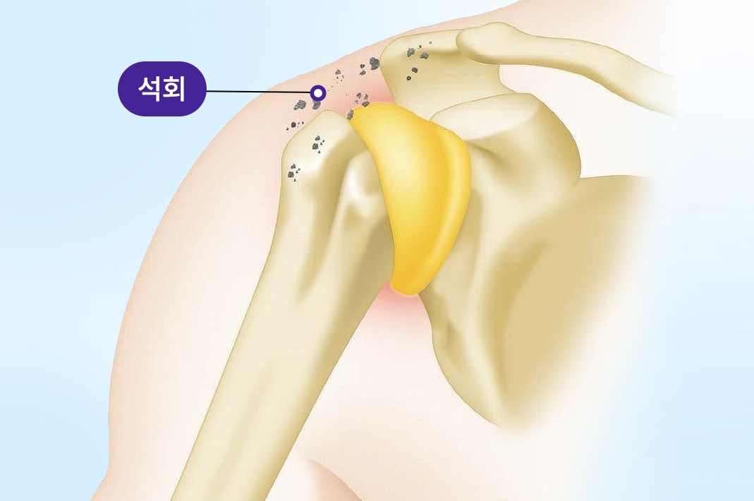 어깨 힘줄 부위에 석회가 침착된 모습을 보여주는 일러스트